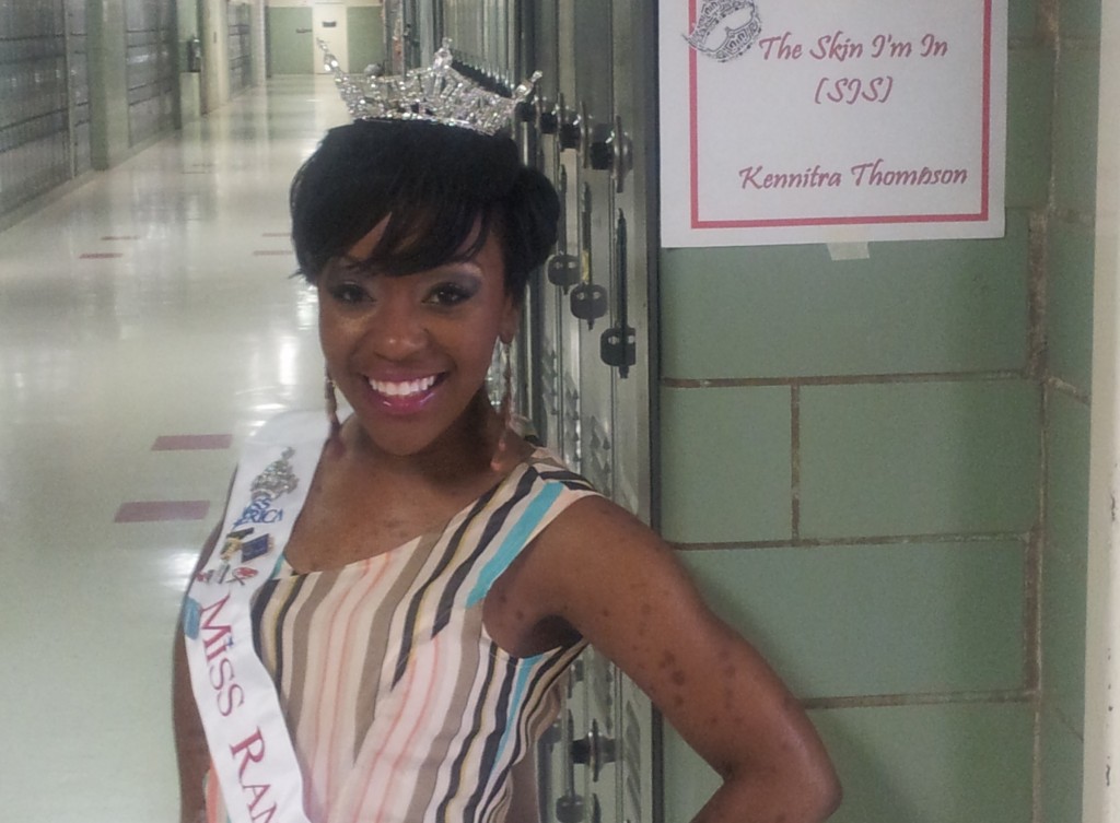 Kennitra Thomas is raising awareness about Steven Johnson Syndrome as she competes for the Miss Mississippi crown.